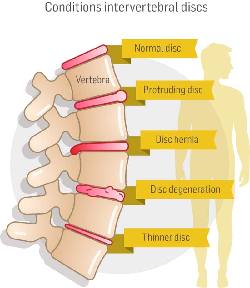 conditions intervertebral discs