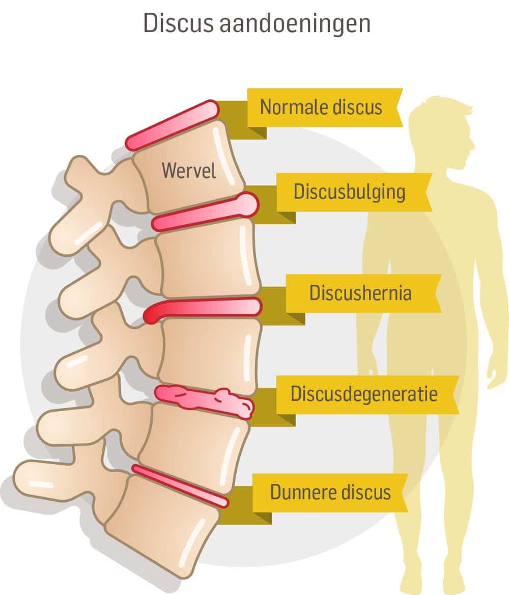 discus aandoeningen