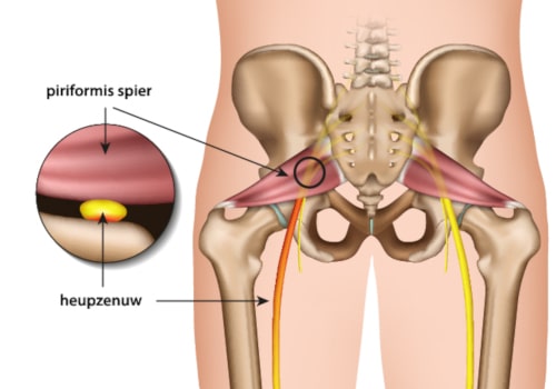 piriformissyndroom spier