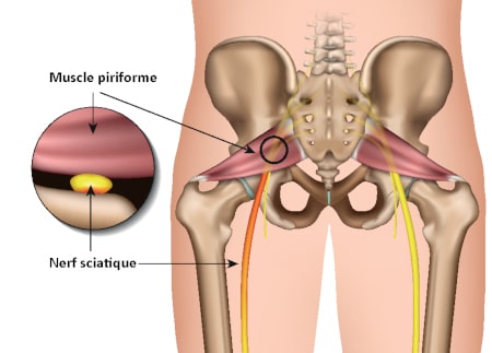 syndrome du piriforme muscle piriforme nerf sciatique