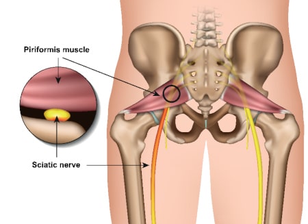 Piriformis syndrome piriformis muscle sciatic nerve